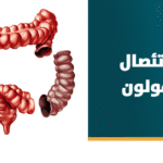 إستئصال القولون بالمنظار