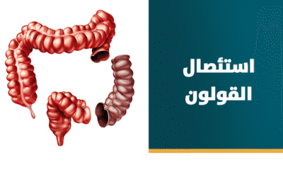 إستئصال القولون بالمنظار