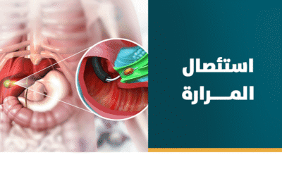 إستئصال المرارة بالمنظار