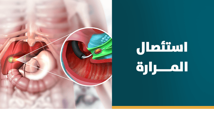 إستئصال المرارة بالمنظار