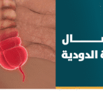 استئصال الزائدة الدوديه بالمنظار