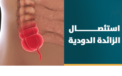 استئصال الزائدة الدوديه بالمنظار