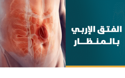 علاج الفتق الإربي بالمنظار