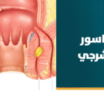 علاج الناسور الشرجي