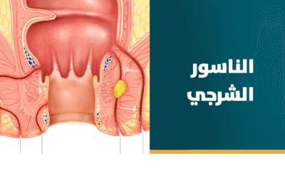 علاج الناسور الشرجي