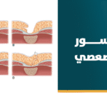 الناسور العصعصي