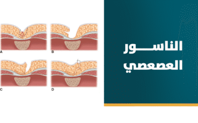 الناسور العصعصي