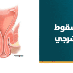 علاج السقوط الشرجي