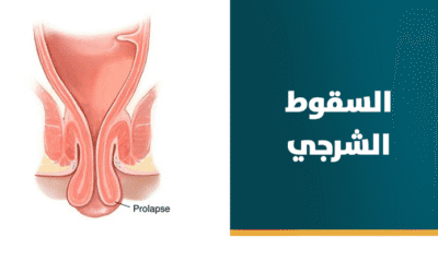 علاج السقوط الشرجي