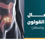 استئصال أورام القولون