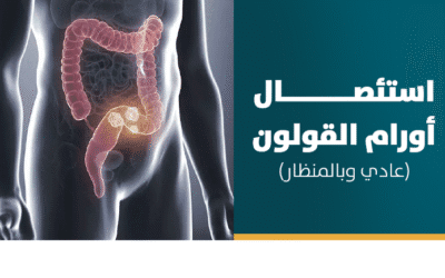 استئصال أورام القولون