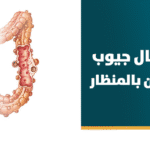 استئصال جيوب القولون بالمنظار