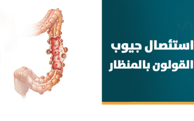استئصال جيوب القولون بالمنظار