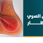 علاج الفتق السُري بالمنظار