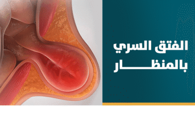 علاج الفتق السُري بالمنظار