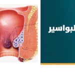 علاج البواسير نهائيًا