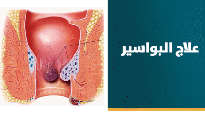علاج البواسير نهائيًا