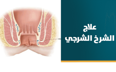 علاج الشرخ الشرجي المزمن بالليزر